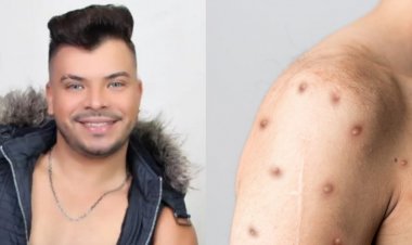 Fotos de cantor paraense que faleceu devido a Mpox viralizam na semana em que o Brasil atinge 90 casos